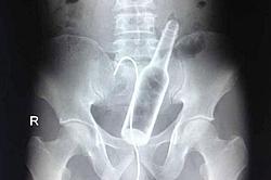 Click image for larger version. 

Name:	X-Ray-of-bottle-stuck-up-mans-bottom-3007510.jpg 
Views:	1 
Size:	22.8 KB 
ID:	83516